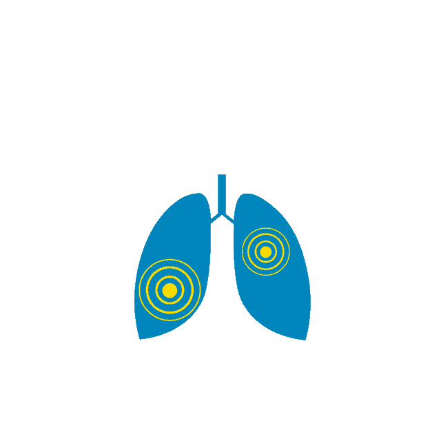 Lung Cancer